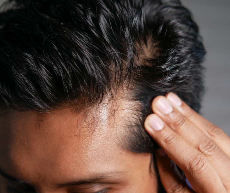 How to Minimize Hair Edges Breakage