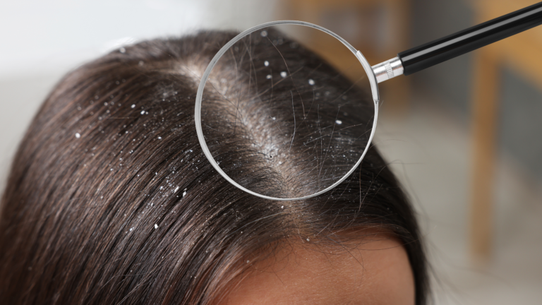 Dandruff vs. Dry Scalp: How to Know the Difference